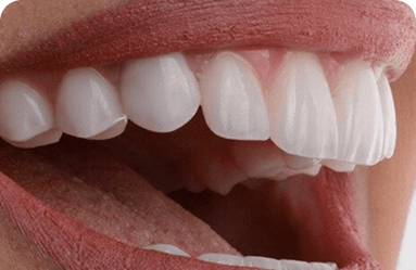 هل تدوم الأسنان التجميلية مدى الحياة