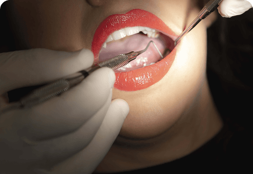We will perform a thorough examination of your teeth and gums to check for any caries or gum disease